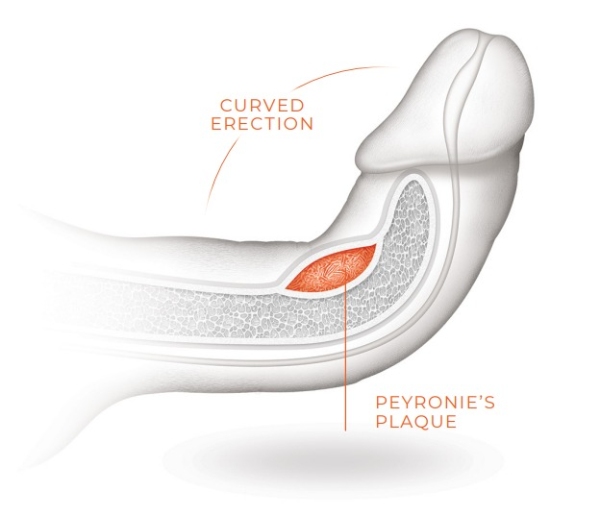 Peyronie’s Disease Kissimmee, FL