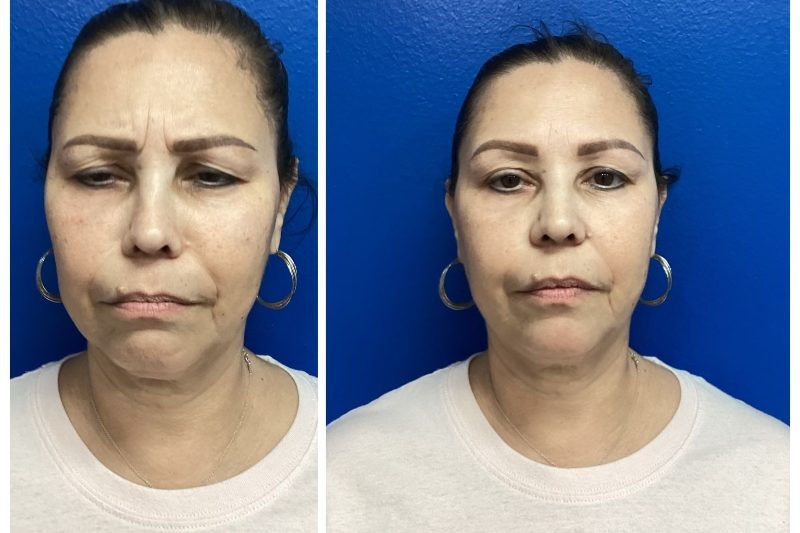 Liquid Facelift 55-65 year old lady