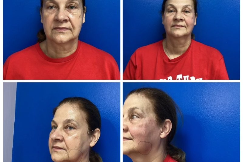 60-65 years old immediately after PDO thread-lift of the face for jowls