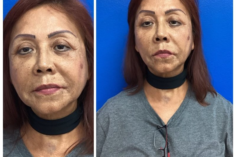60-70 years old after liquid face lift