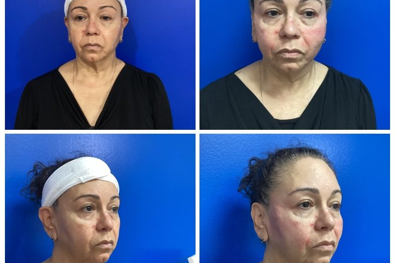 50-60 years old immediately after PDO Thread Lift face