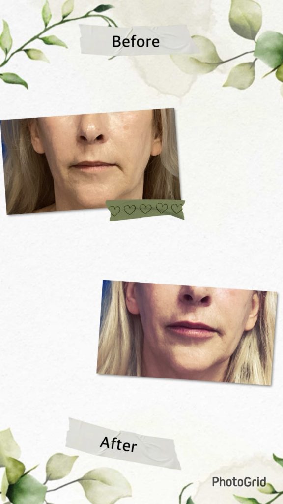 55-60 year old lady after Juvederm lip filler
