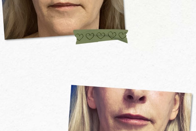 55-60 year old lady after Juvederm lip filler