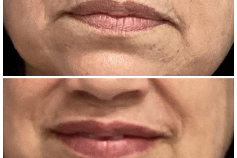 Lip Filler for Lip Lines and Thinning Lips