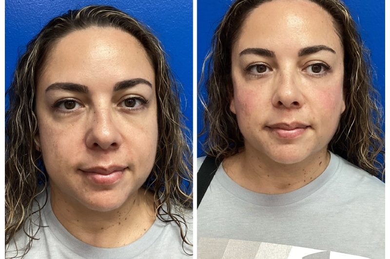 PRP Therapy with Filler