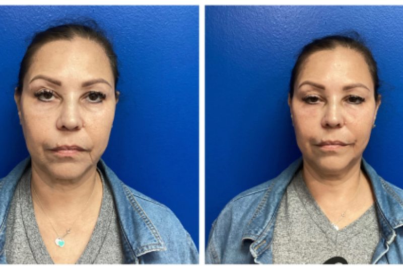 PRP with filler for under eyes, hollows and jowls