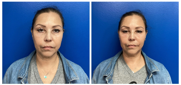 PRP with filler for under eyes, hollows and jowls
