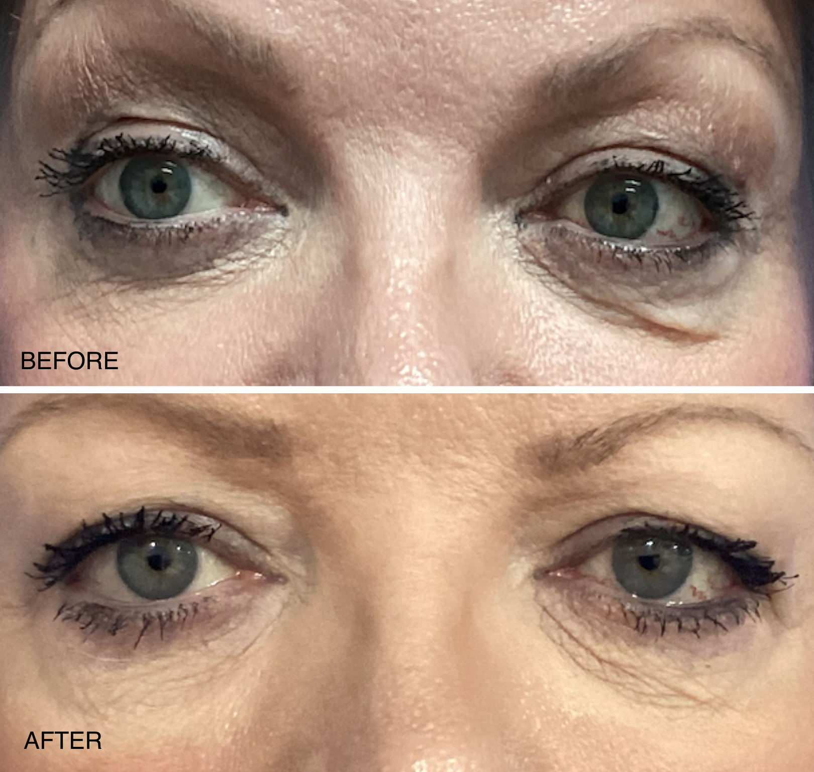 Existing before-and-after comparison of the eye area following one VelaShape treatment; before above, after below.